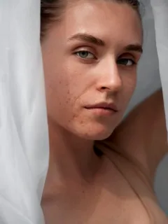 How to Get Rid of Acne Scars: A Comprehensive Guide - Cover Image
