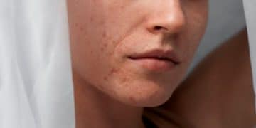 How to Get Rid of Acne Scars: A Comprehensive Guide - Cover Image